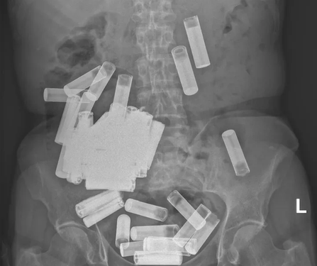 Рентген батарейок у шлунку пацієнта